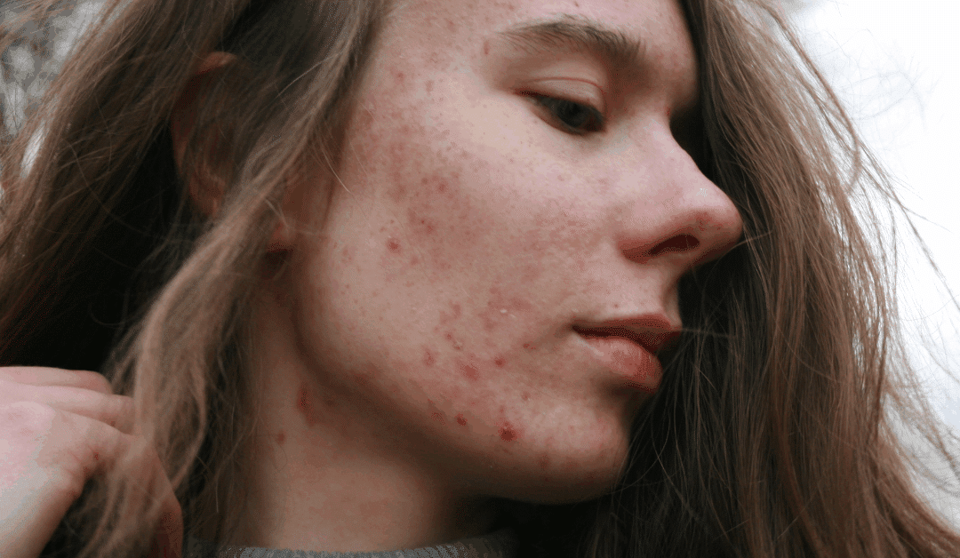 Skin-Deep: How Nutrition Impacts Acne and Clearer Skin