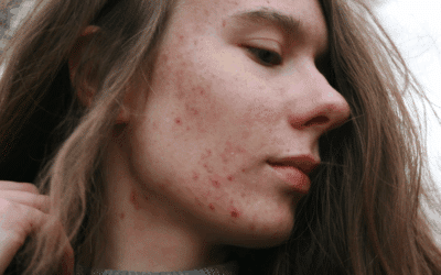 Skin-Deep: How Nutrition Impacts Acne and Clearer Skin